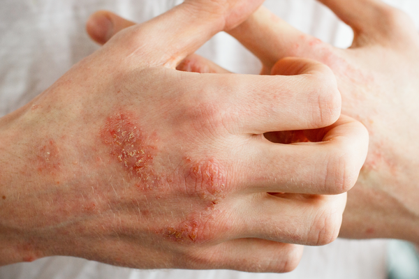 Eczema Relief: Simple Tips and Ingredients to Soothe Your Skin
