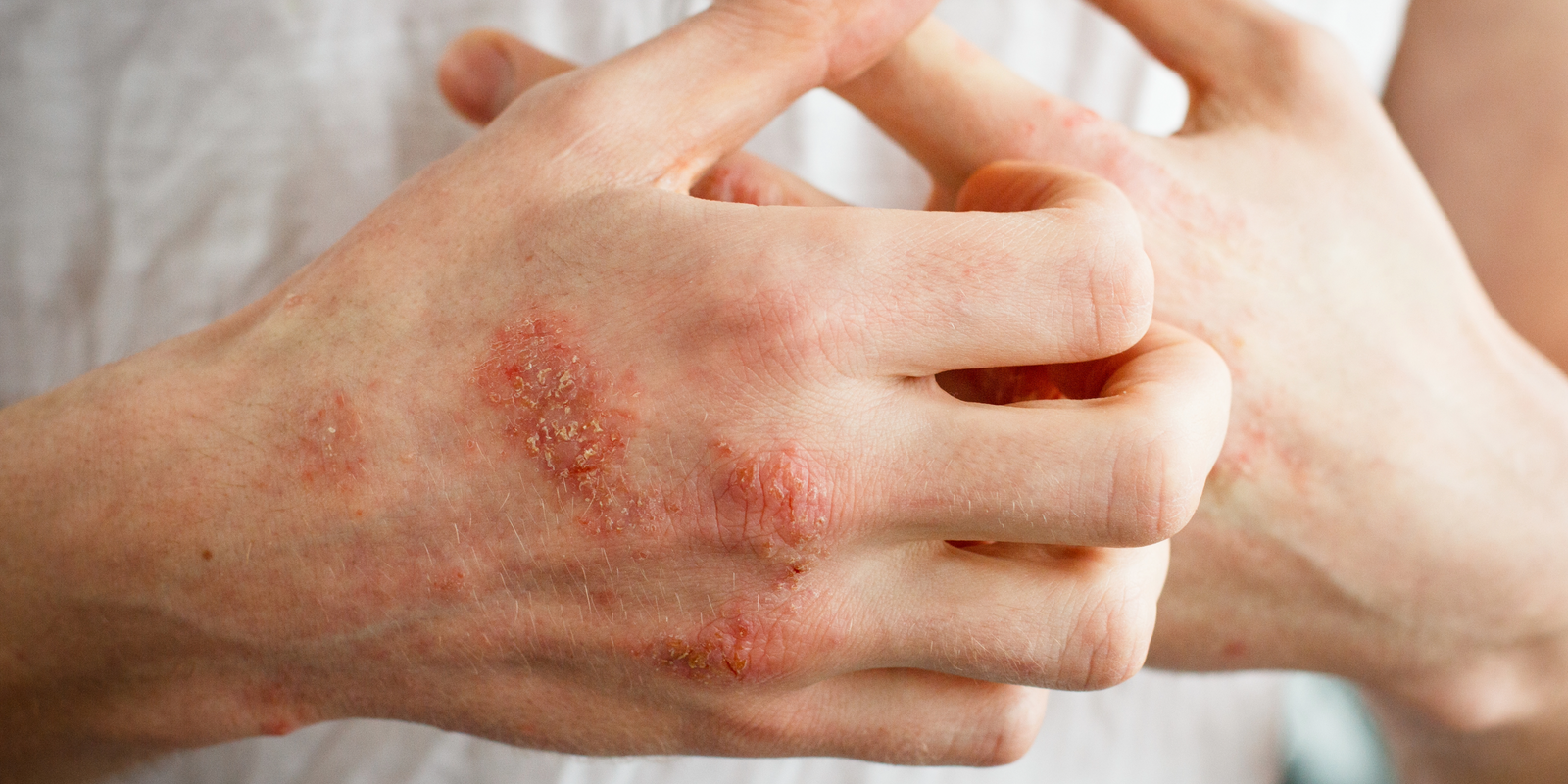 Eczema Relief: Simple Tips and Ingredients to Soothe Your Skin