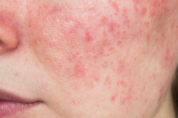 Managing Redness and Irritation From Rosacea: Tips, Triggers, and Ingredients to Know