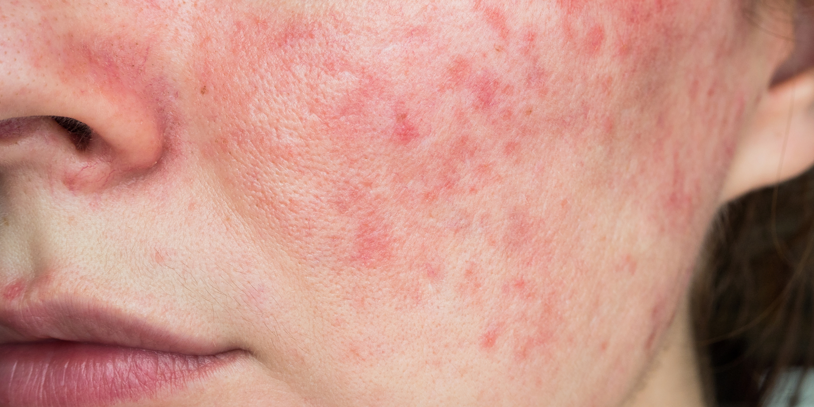 Managing Redness and Irritation From Rosacea: Tips, Triggers, and Ingredients to Know