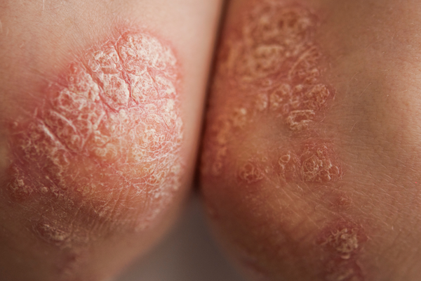 Psoriasis Flare-Ups: Gentle Products and Holistic Tips That Help