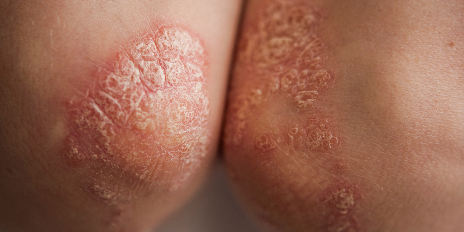 image of psoriasis plaques on the elbows
