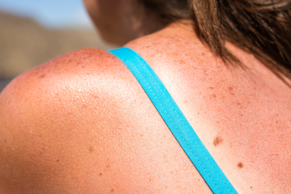 #AskGraydon: Is There a Way to Heal Sun Damage After the Fact?